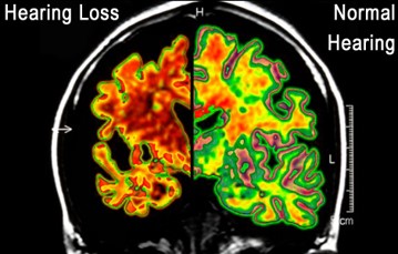 hearing loss vs. normal hearing shown in brain scan
