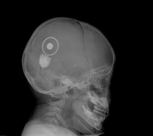 cochlear implant x-ray