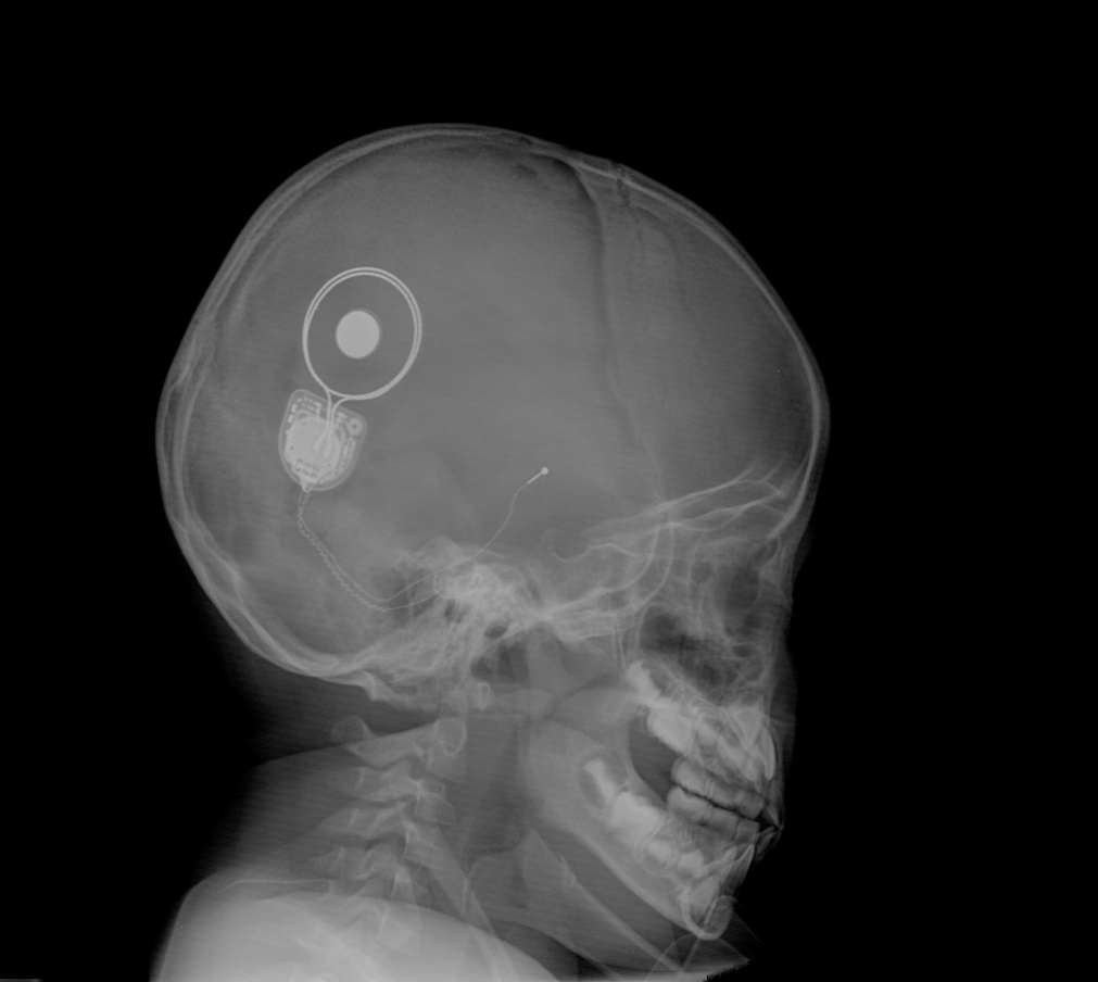 Cochlear Implant Mapping